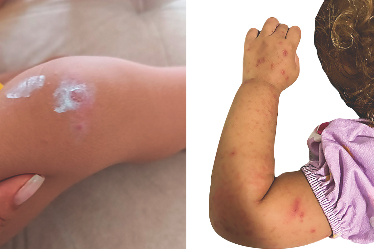Bernardo, de 1 ano e 8 meses, e Eva, de 2, tiveram febre alta e várias lesões pelo corpo